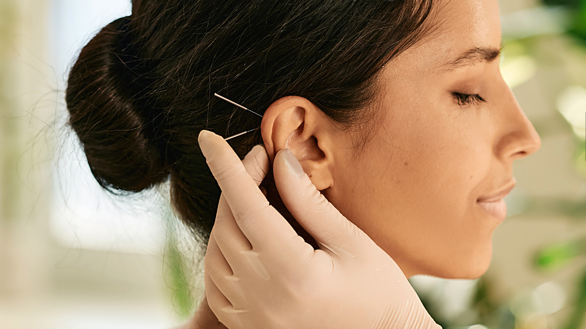 ¿Qué es la acupuntura auricular? Beneficios y técnicas