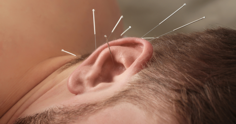 ¿Qué es la acupuntura auricular? Beneficios y técnicas